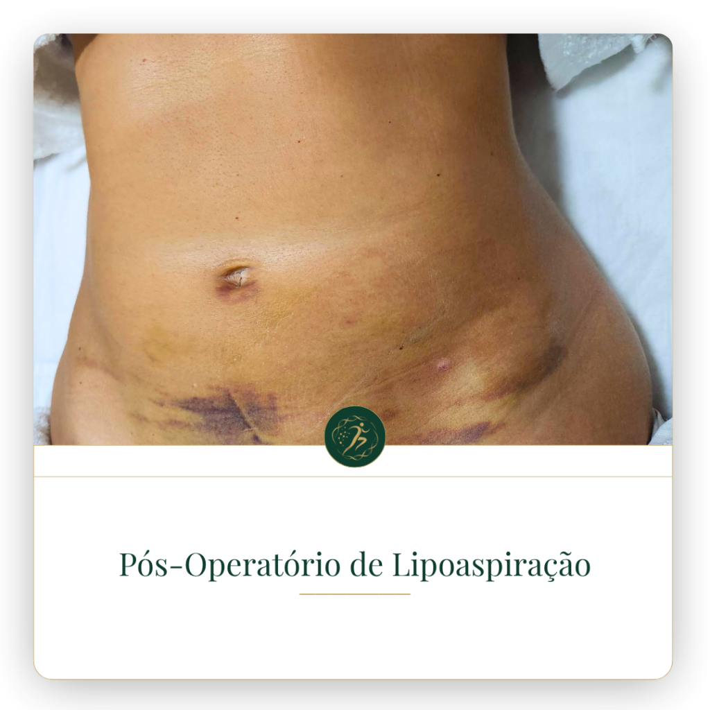 lipo